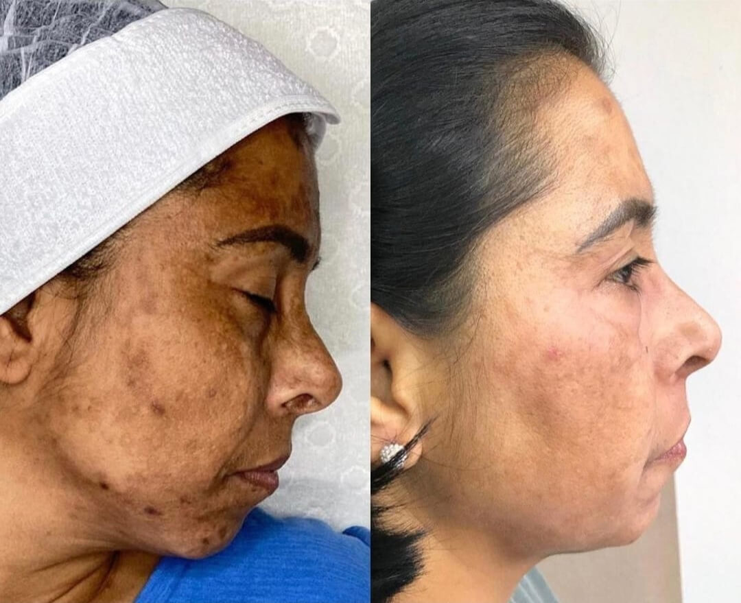 melasma-resultado-1