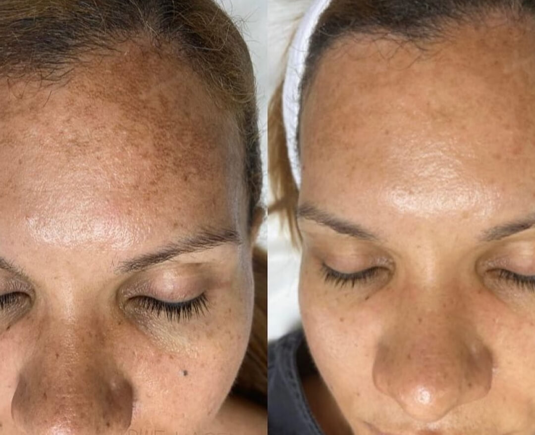 melasma-resultado-3