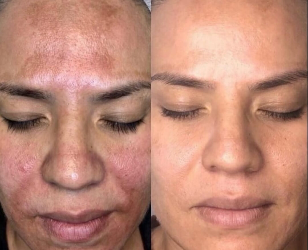 melasma-resultado-4