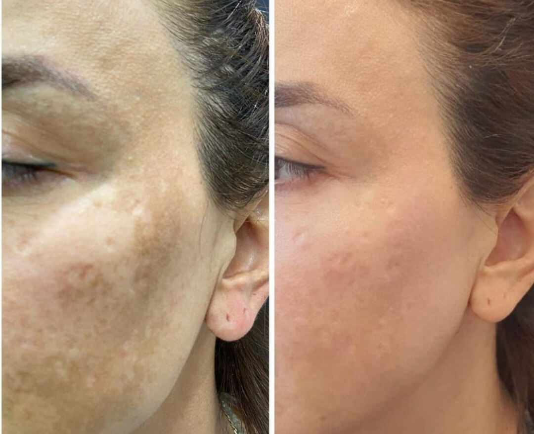 melasma-resultado-5