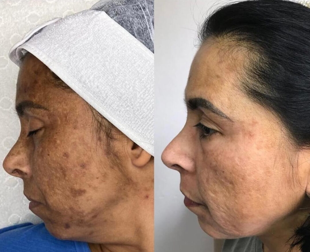 melasma-resultado